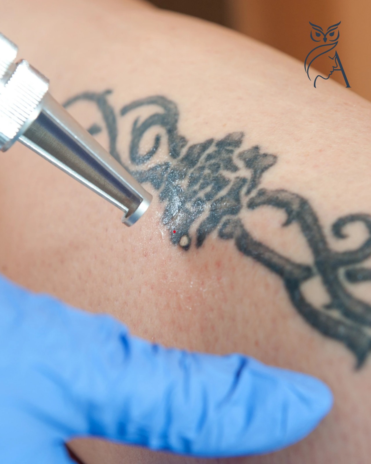 Imagen de ELIMINACIÓN DE TATUAJE